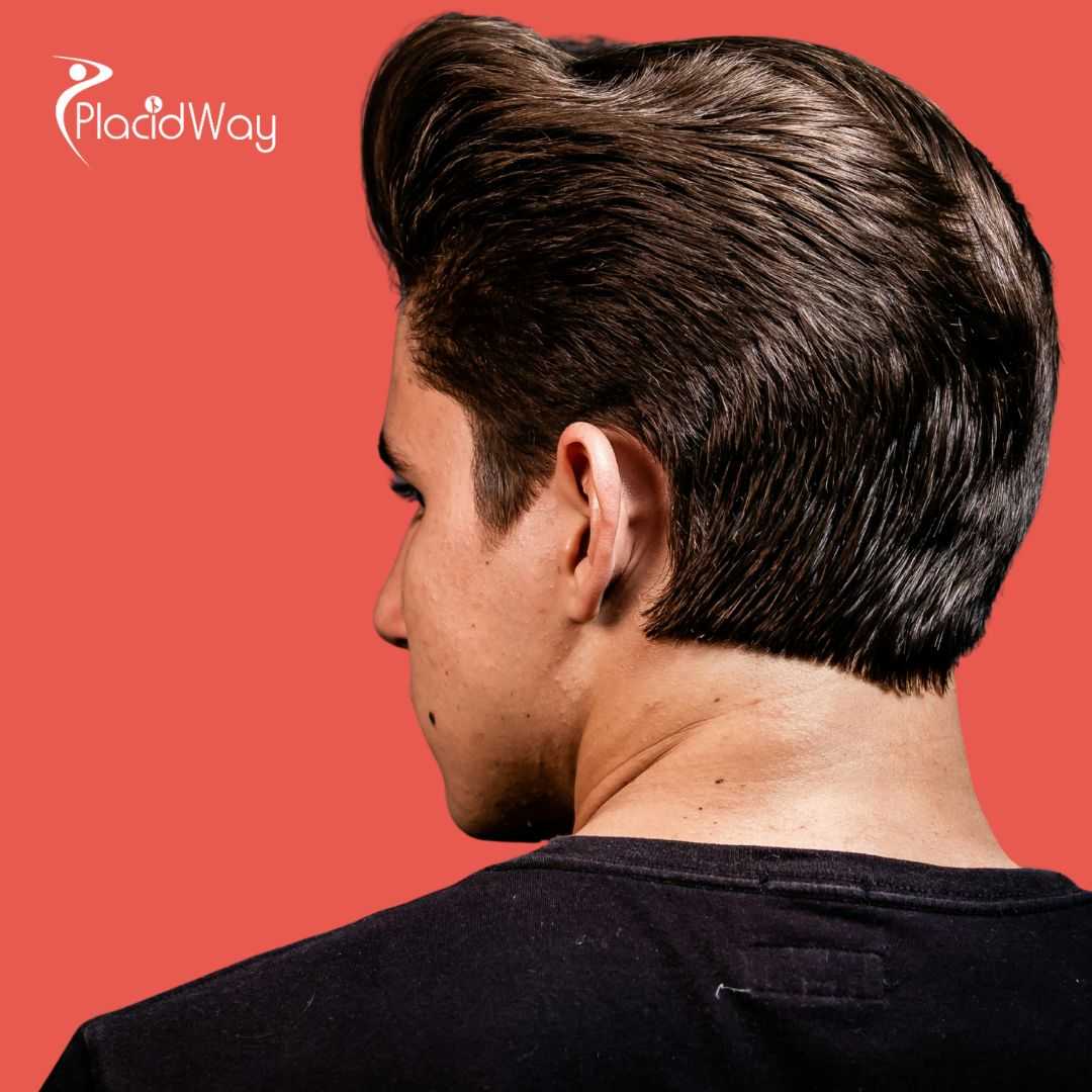 Stem Cell Therapy for Hair Loss Package in Tijuana, Mexico by CellsTime Clinique