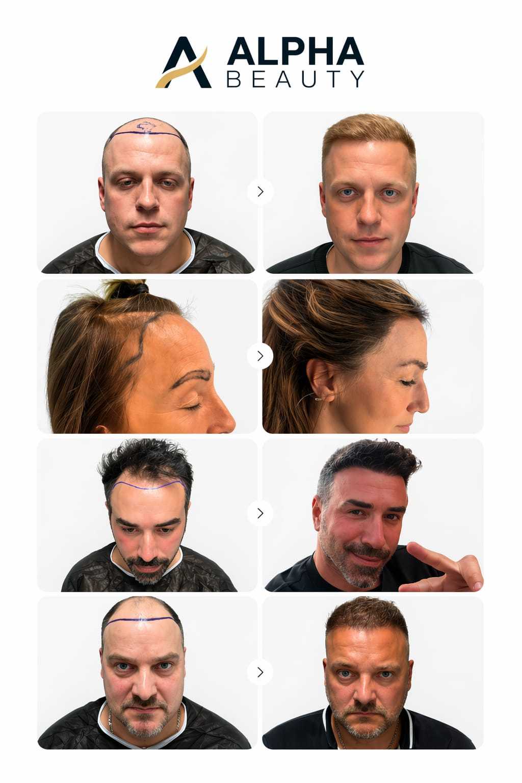 Hair Transplant Procedure – Germany (Premium Care)