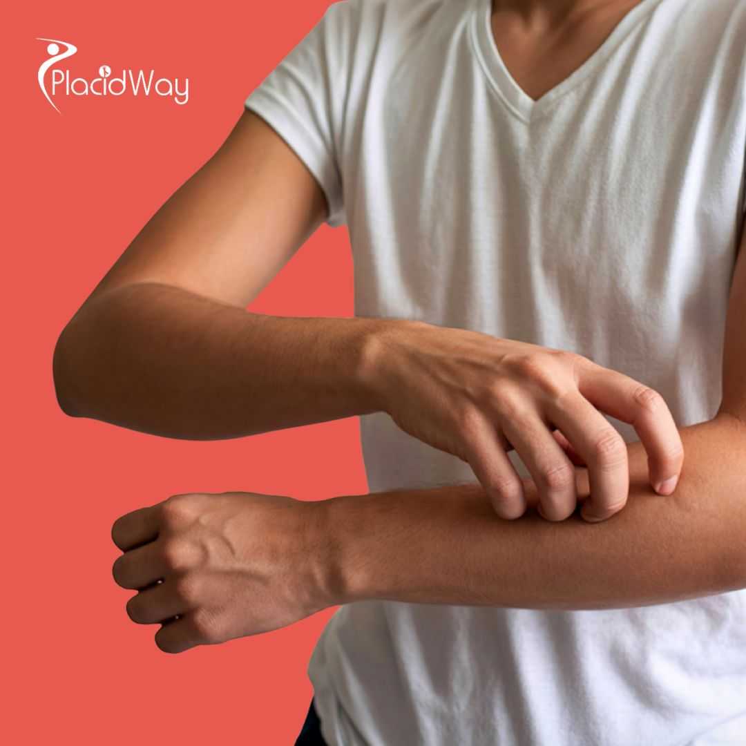 Stem Cell Therapy for Psoriatic Arthritis Package in Tijuana, Mexico by CellsTime Clinique