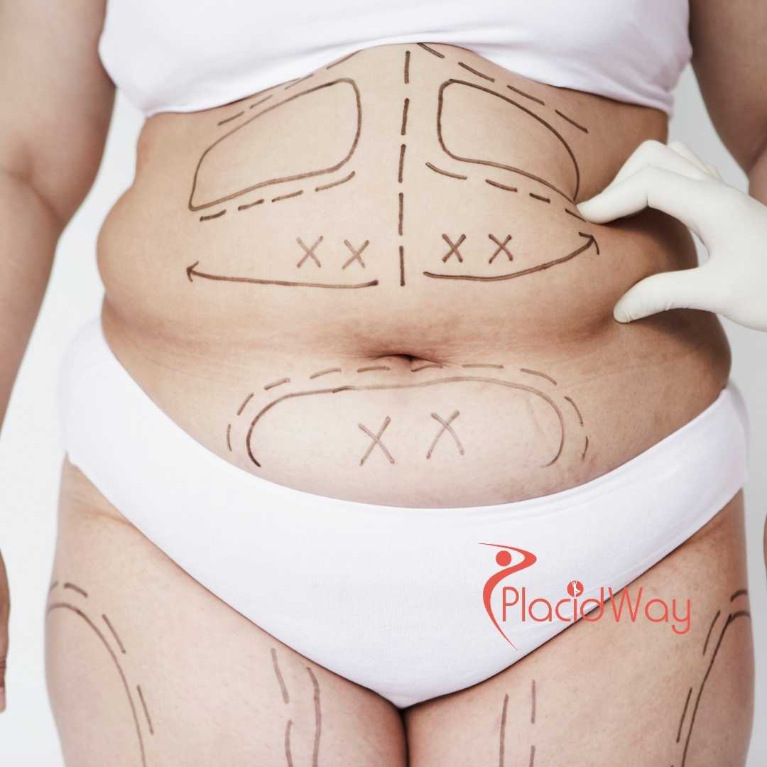 Comprehensive Mommy Makeover Package by Dr. Israel Villalobos