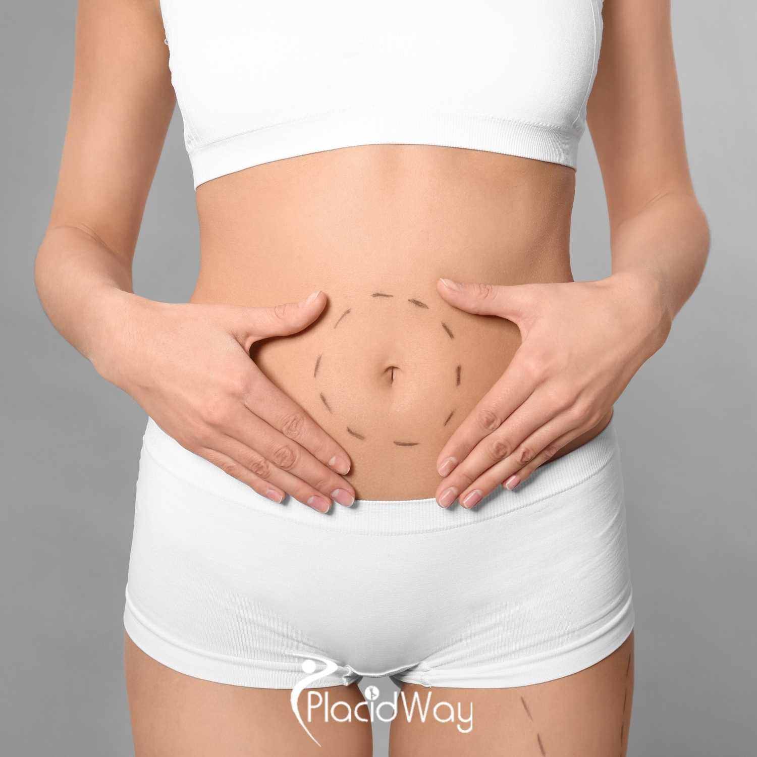 360 Tummy Liposuction in Seoul, Korea by Evita Plastic Clinic