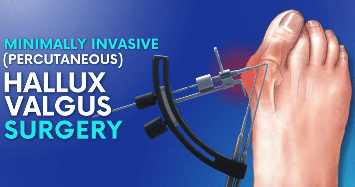 Hallux Valgus / Bunionectomy Surgery with LAPIDUS 3D Technology in Istanbul, Turkey
