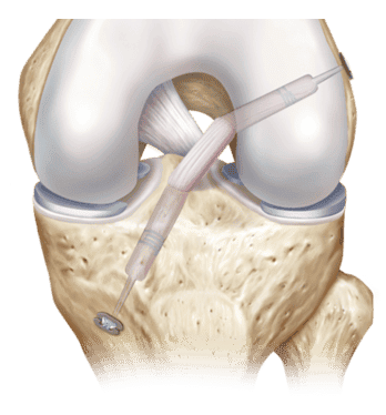 Arthroscopic Anterior Cruciate Ligament (ACL) Repair Surgery Package in Turkey