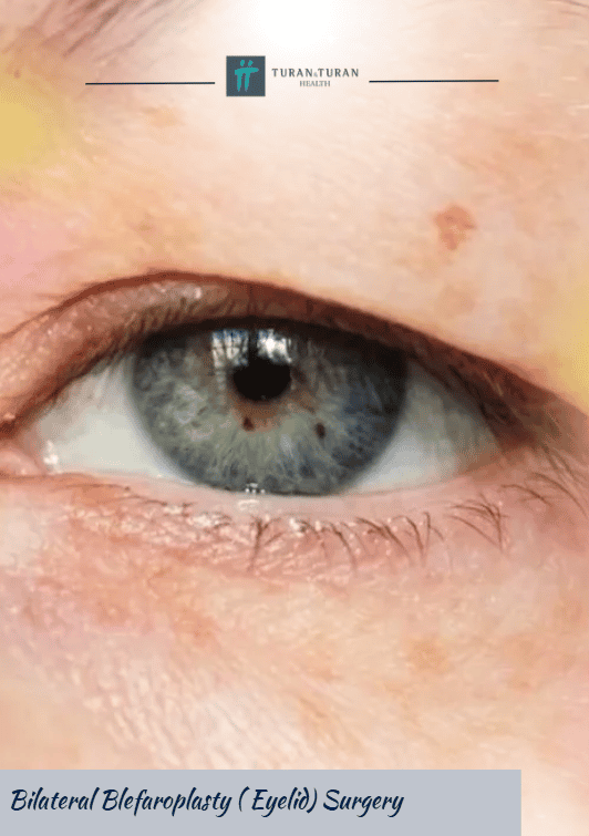 Bilateral Blefaroplasty (Eyelid) Surgery
