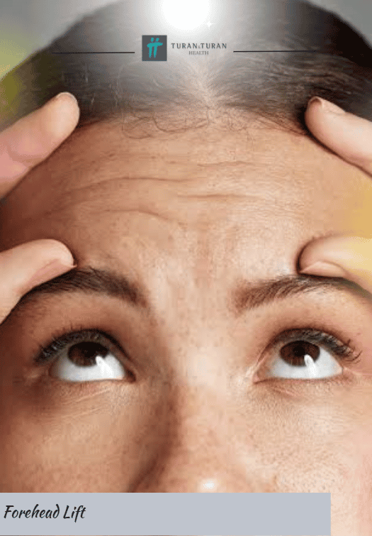 Forehead Lift