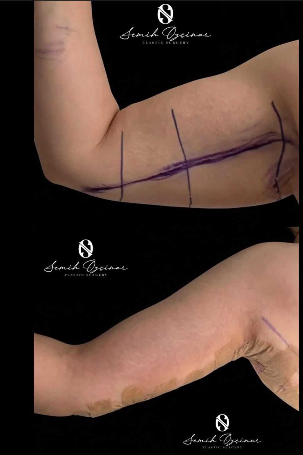 Arm Lift (Brachioplasty Surgery)