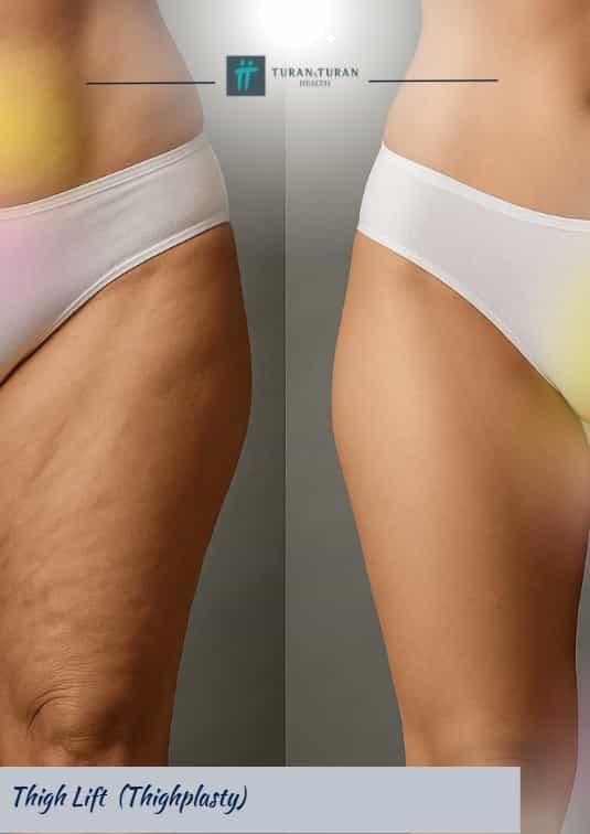 Thigh Lift Surgery Package in Istanbul, Turkey by Turan Turan