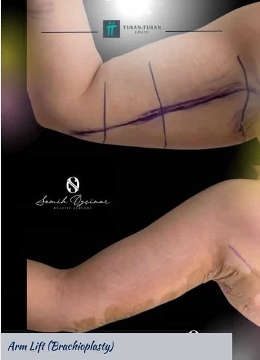 Arm Lift Package in Istanbul, Turkey by Turan Turan