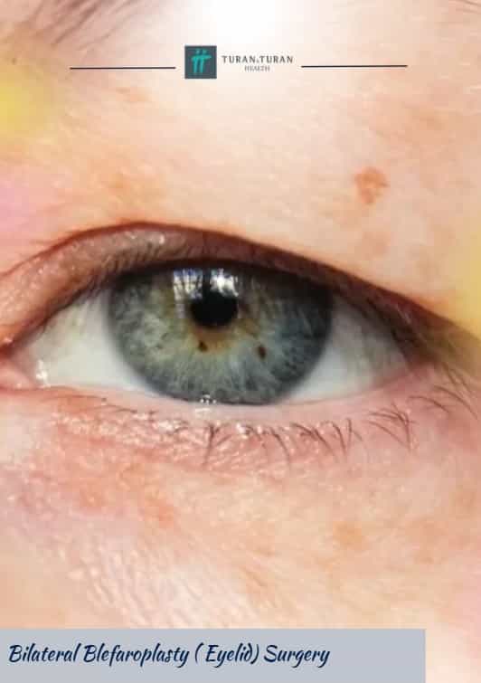 Bilateral Blepharoplasty Surgery Package by Turan Turan in Istanbul, Turkey