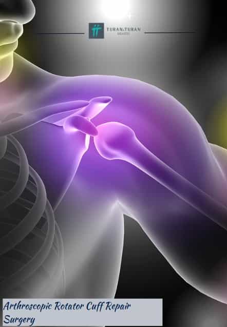 Arthroscopic Rotator Cuff Surgery Package in Istanbul, Turkey by Turan Turan