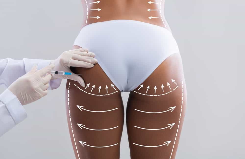 Brazilian Butt Lift (BBL)