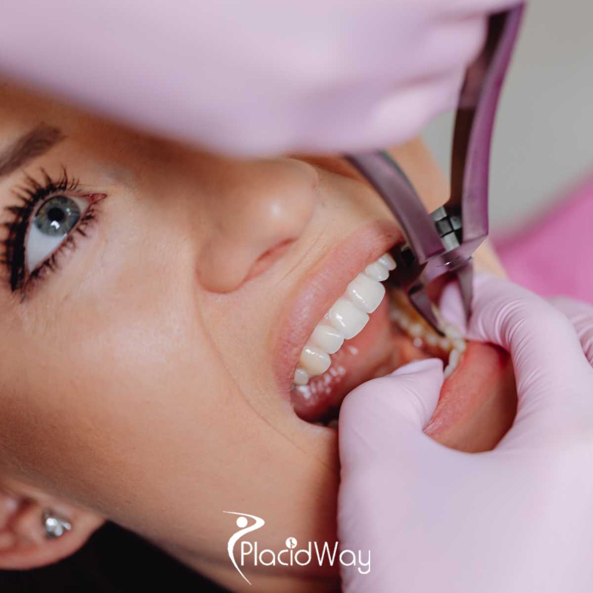 Affordable All on 4 Dental Implants Package in Izmir, Turkey