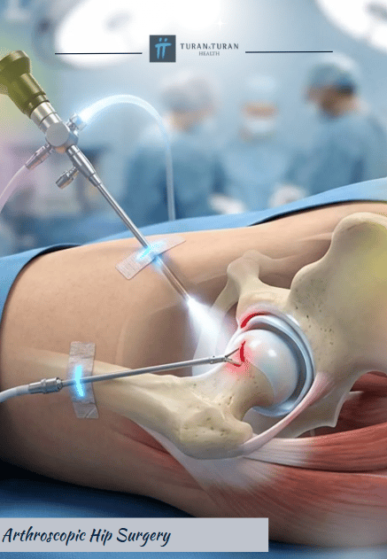 Minimally Invasive Hip Arthroscopy Surgery Package in Istanbul, Turkey by Turan Turan