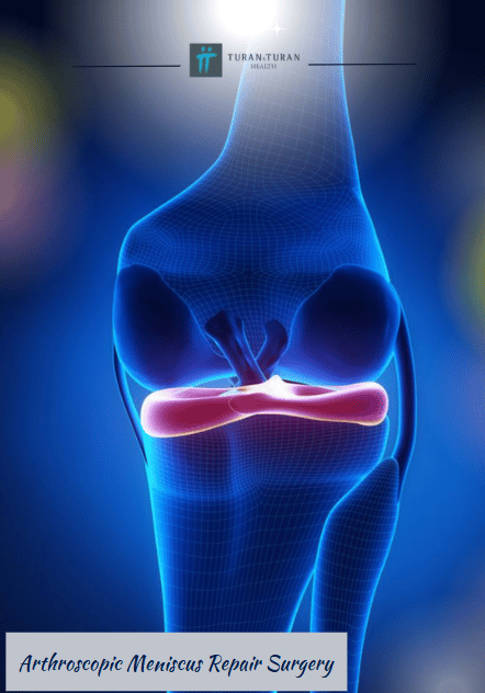 Arthroscopic Meniscus Repair Surgery Package in Istanbul, Turkey by Turan Turan