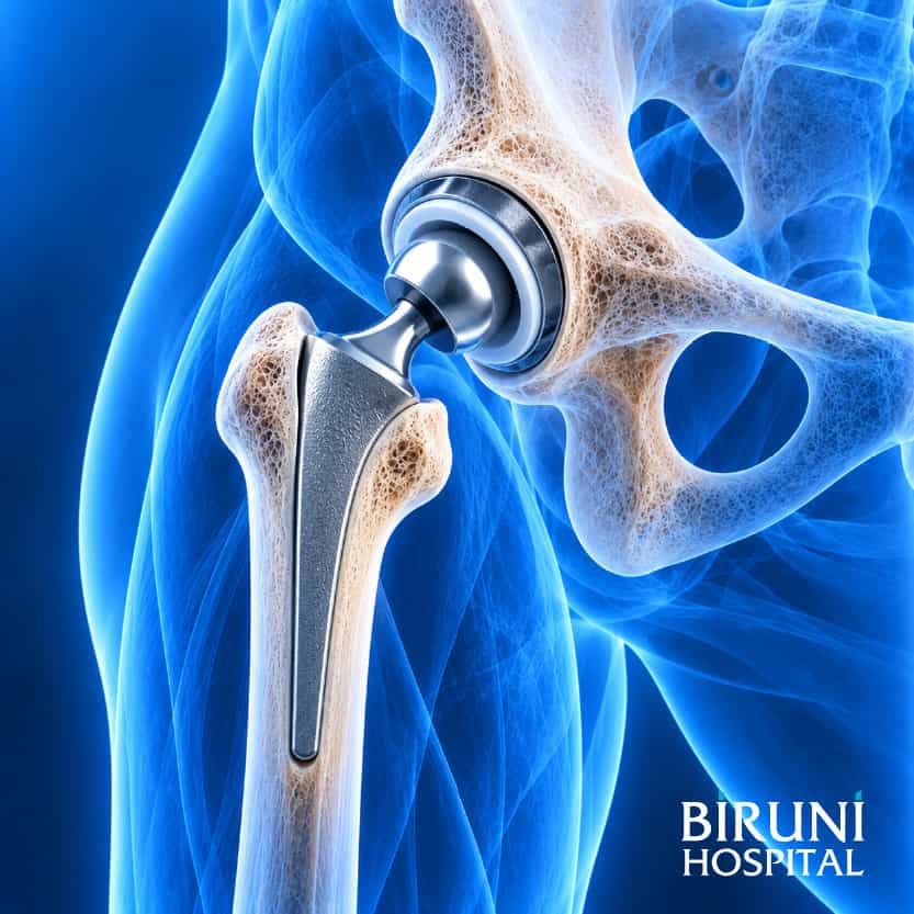 Hip Replacement Surgery Package in Istanbul, Turkey by Biruni Hospital