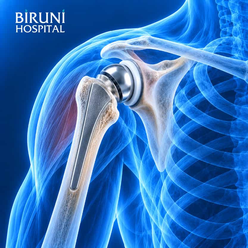 Shoulder Resection Arthroplasty Package in Istanbul Turkey by Biruni Hospital