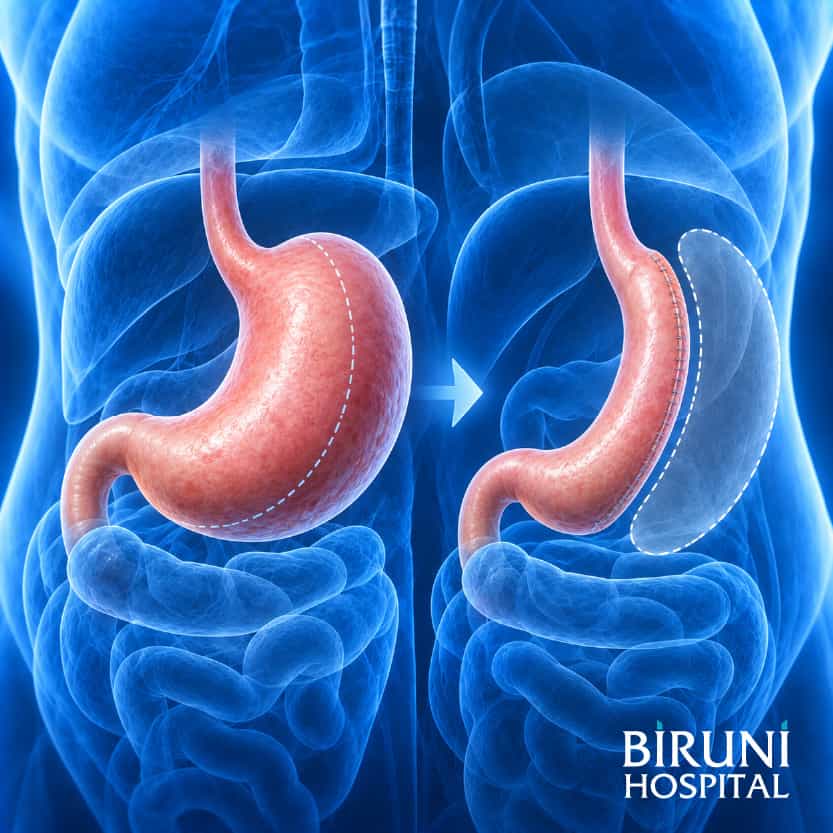 Sleeve Gastrectomy Package in Istanbul Turkey by Biruni Hospital