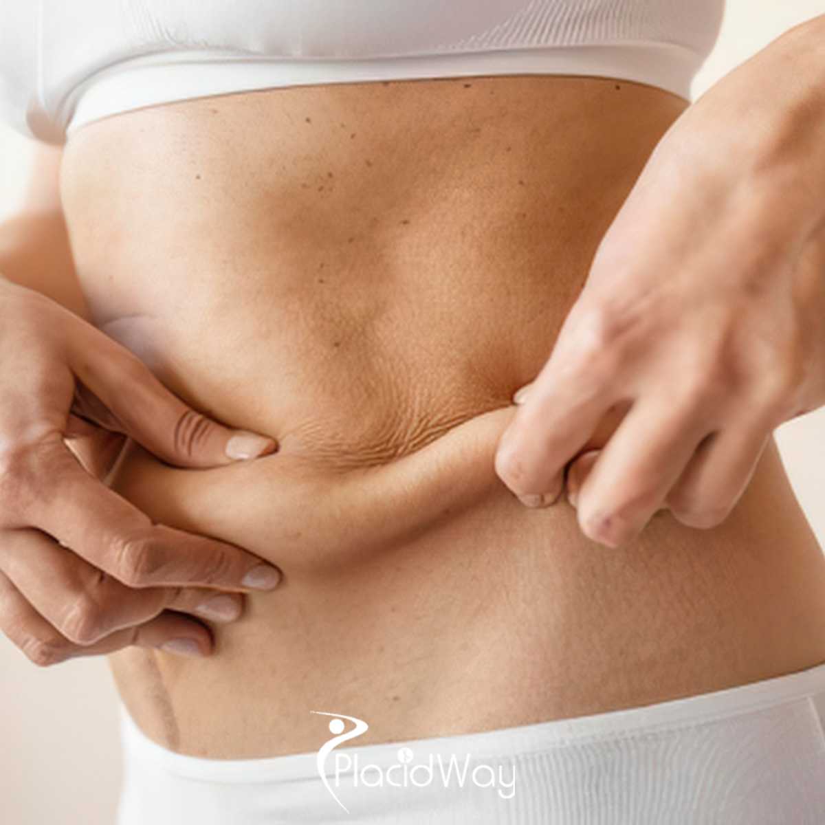 Gastric Sleeve Package in Mexicali, Mexico