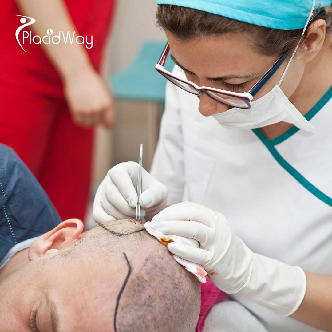 Hair Transplant Package in Istanbul, Turkey for Overseas Patients Experiencing Hair Loss