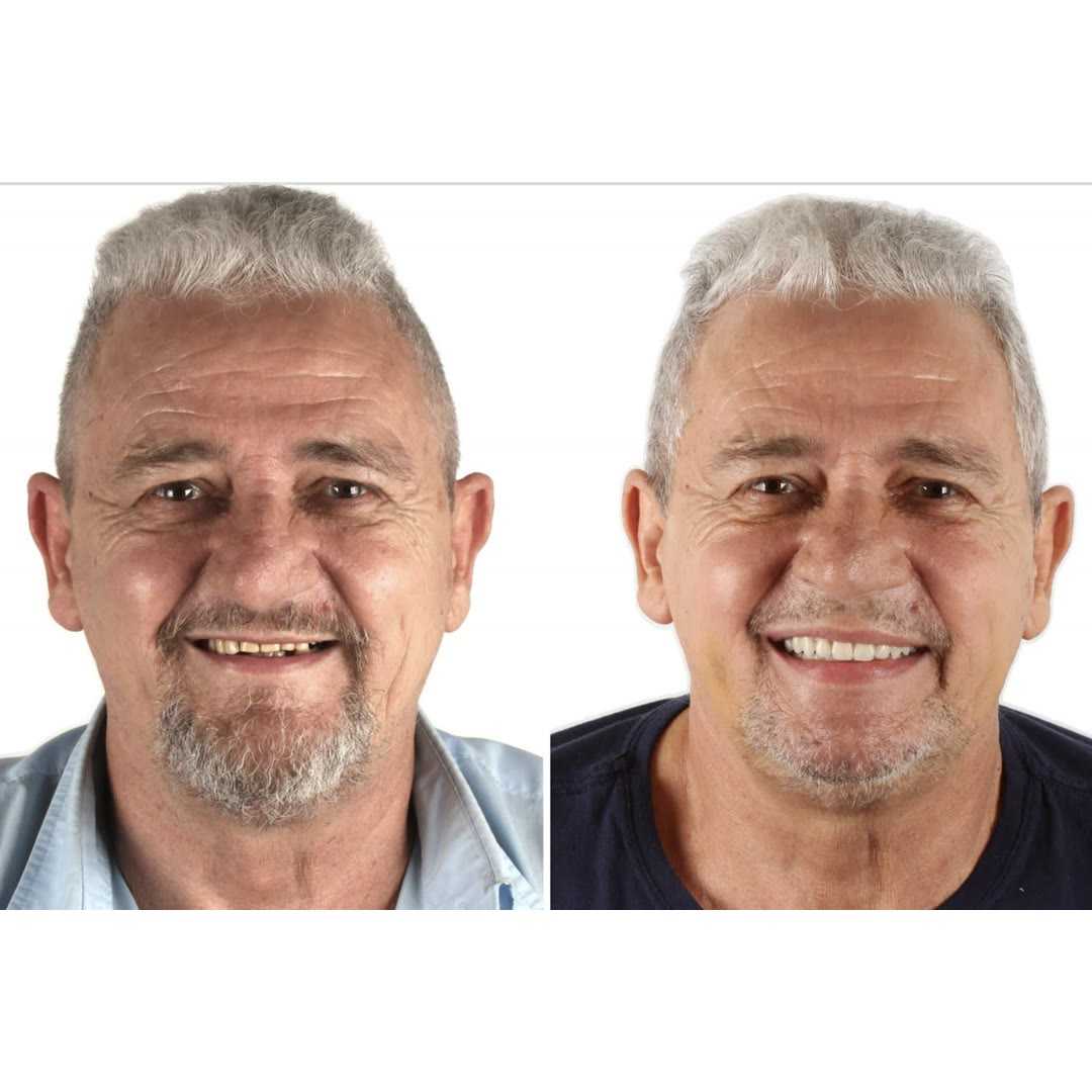 Zygomatic Implants Full Arch Package in Blumenau, Brazil