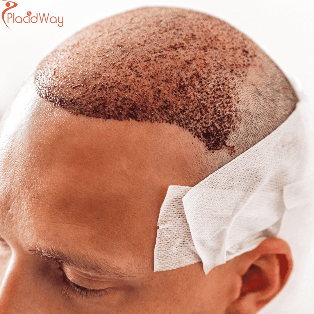 How Much Does a Hair Transplant Cost in India?