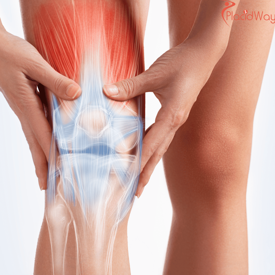 How Much Does Knee Surgery Cost in Germany?