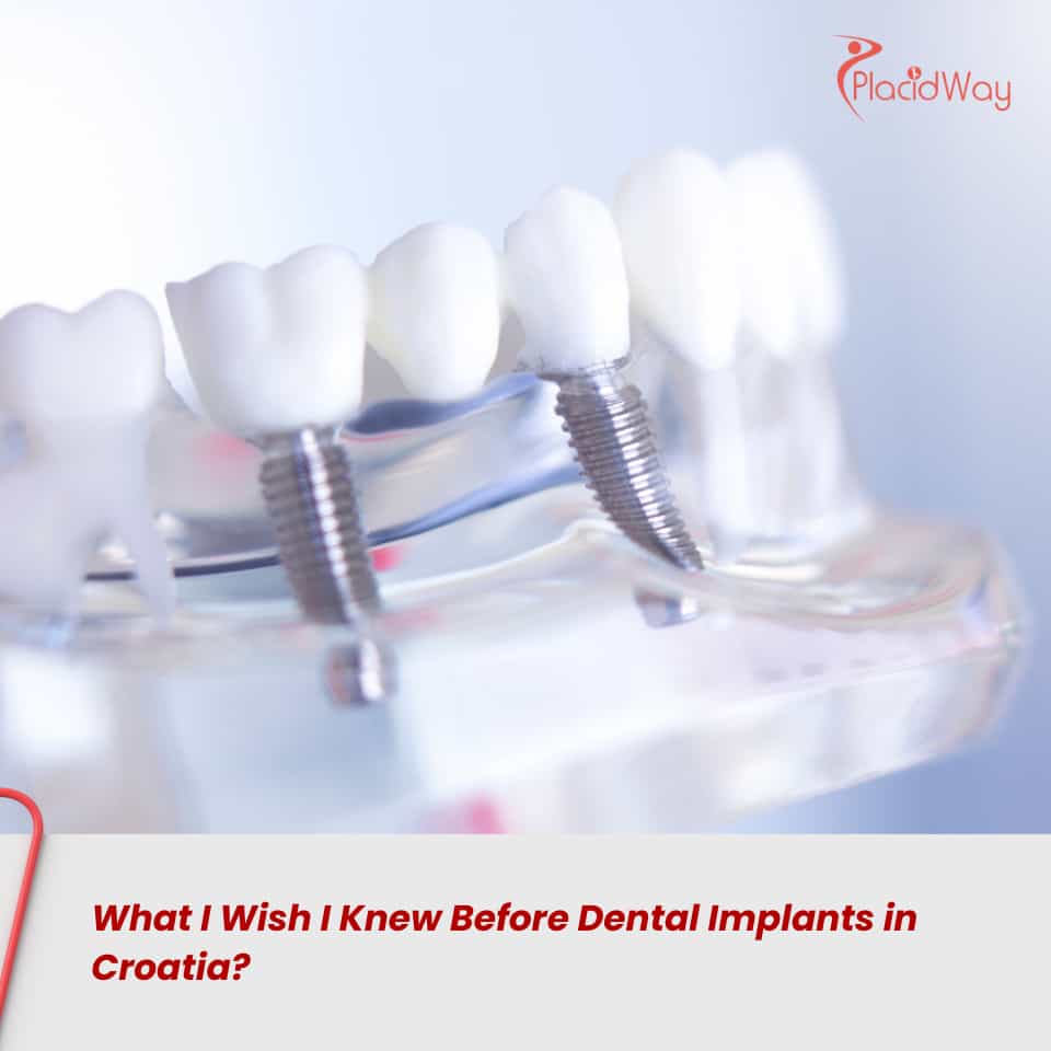What I Wish I Knew Before Dental Implants in Croatia?