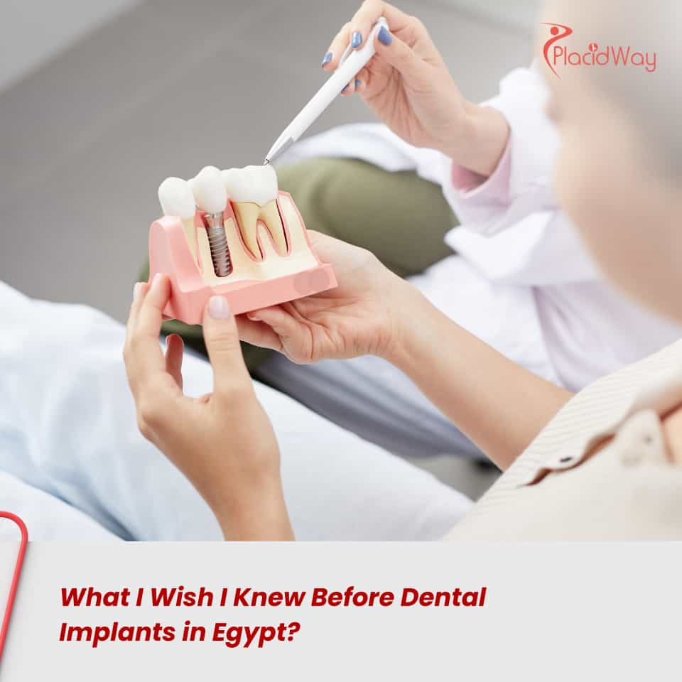 What I Wish I Knew Before Dental Implants in Egypt?