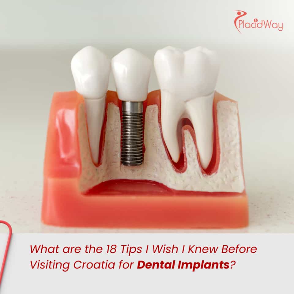 What are the 18 Tips I Wish I Knew Before Visiting Croatia for Dental Implants?