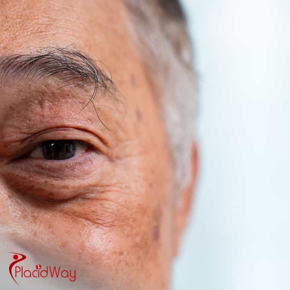 Where to find affordable cataract surgery in Tijuana?
