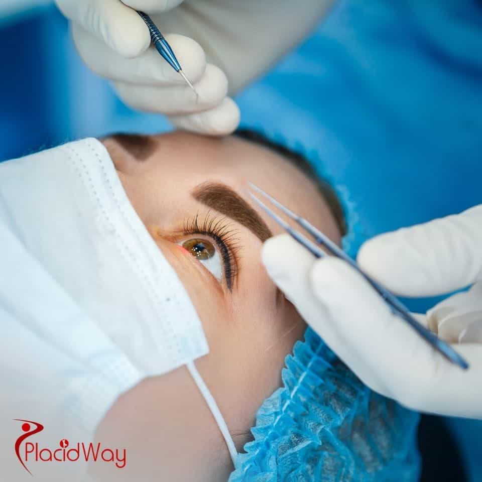 How is laser cataract surgery performed in Mexico?