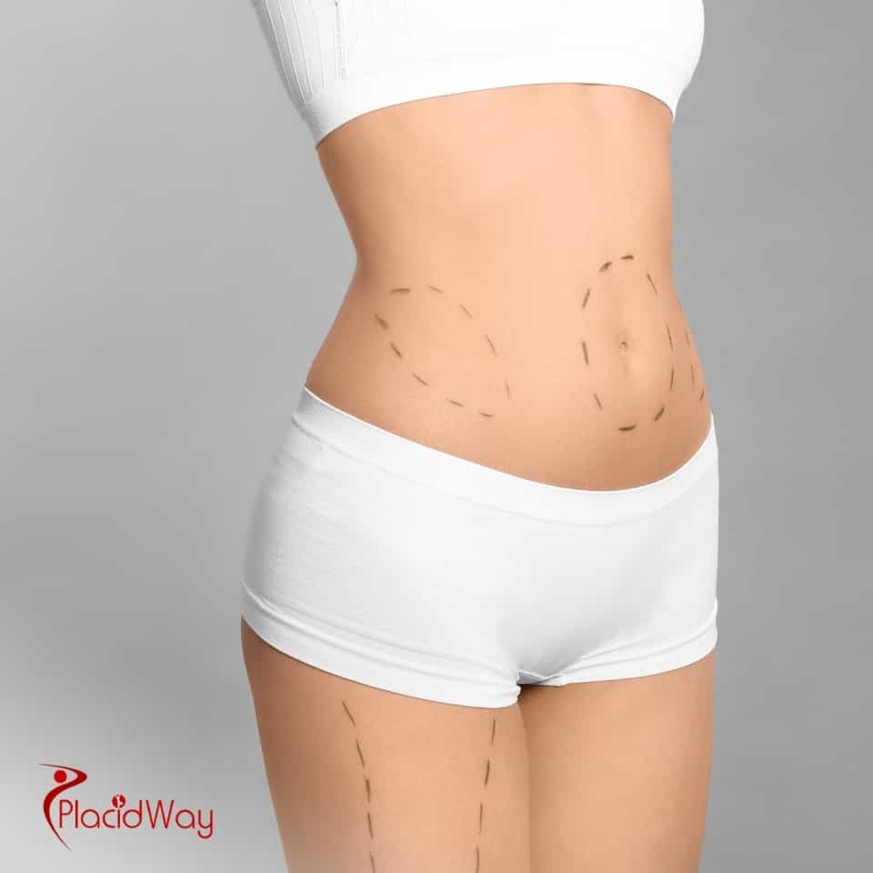 Welches Land bietet die günstigsten Fettabsaugungen an?