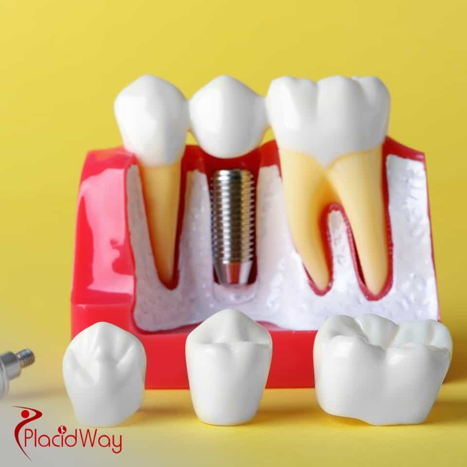 Where Can I Get Dental Implants In Croatia?