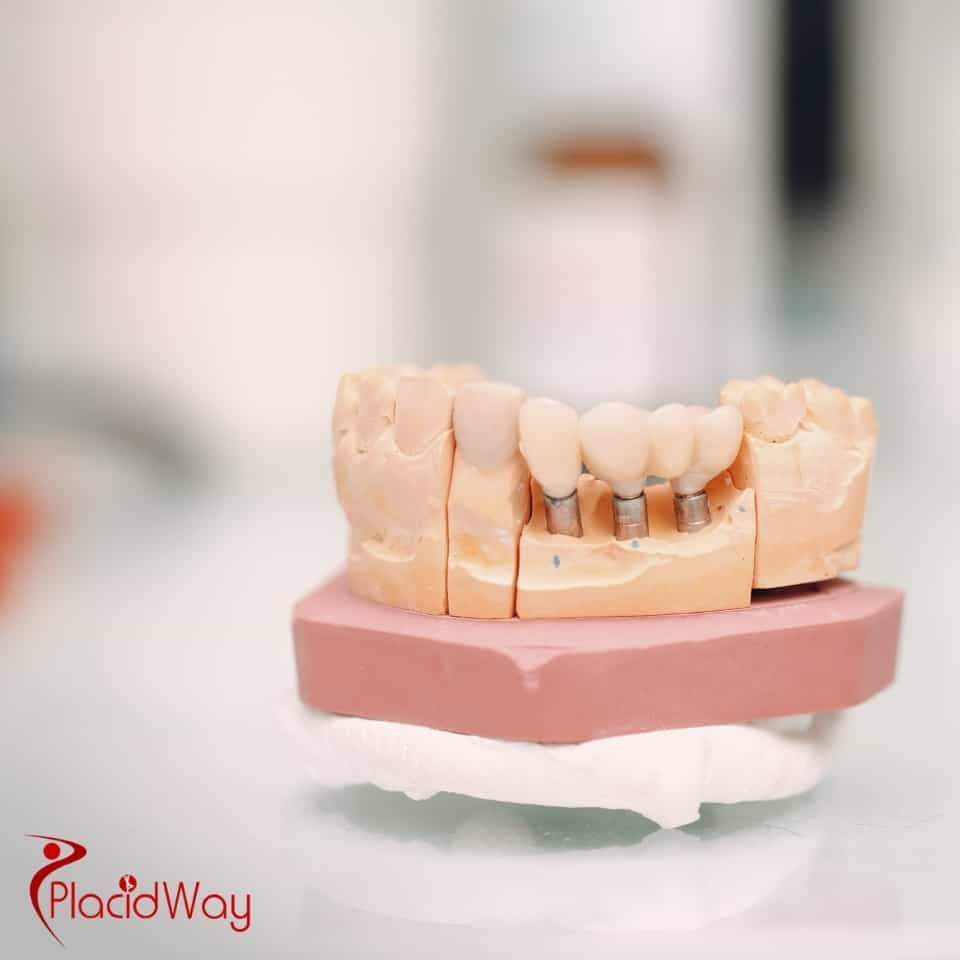 How Much Do All on 4 Dental Implants Cost in Thailand in 2025?