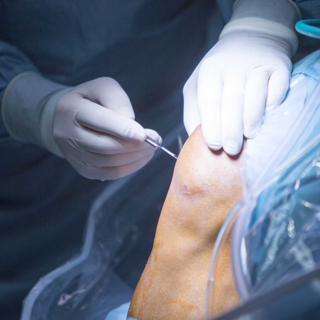 Can you Recover 100% from a Meniscus Tear?