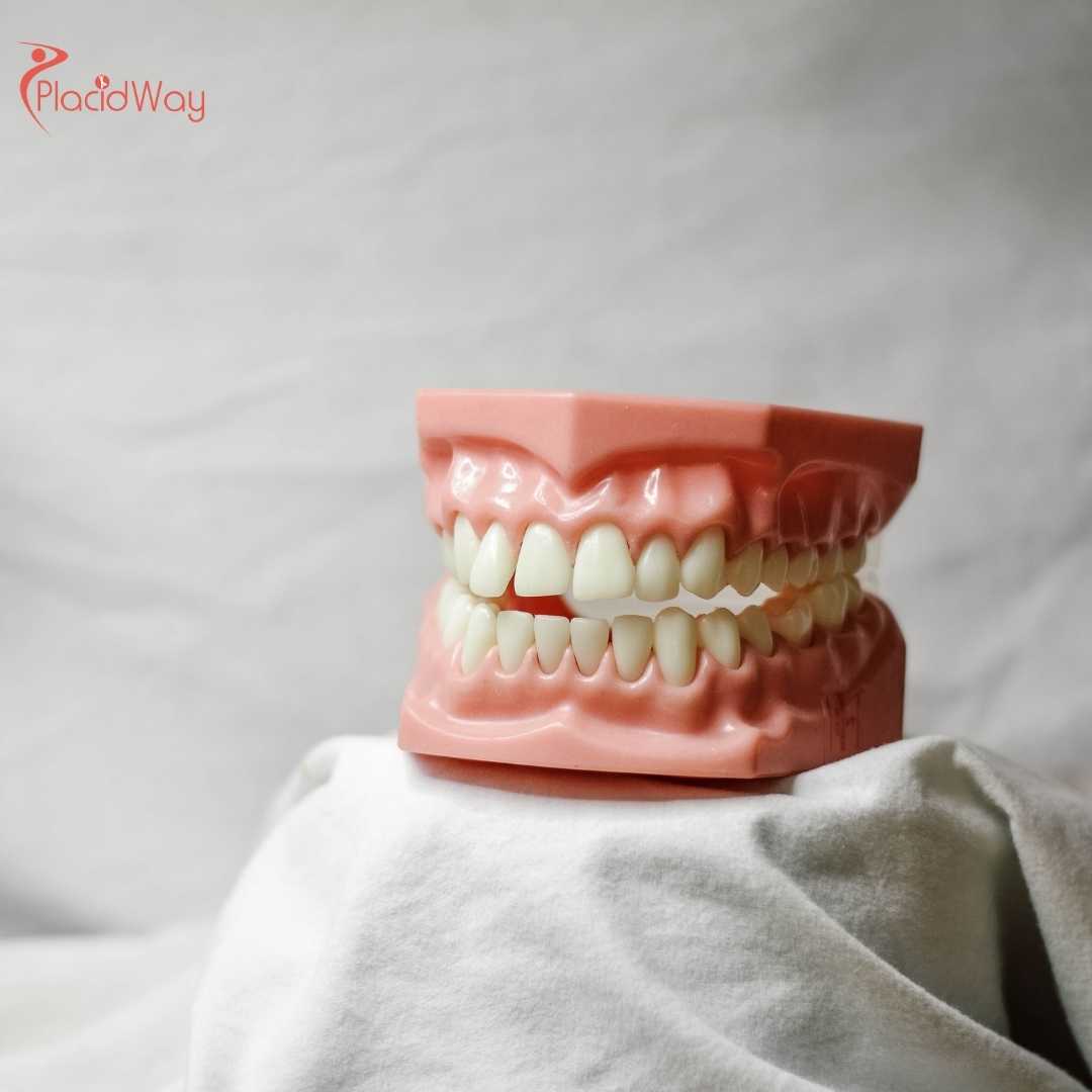 Is It Safe to Get Dental Implants in Colombia?