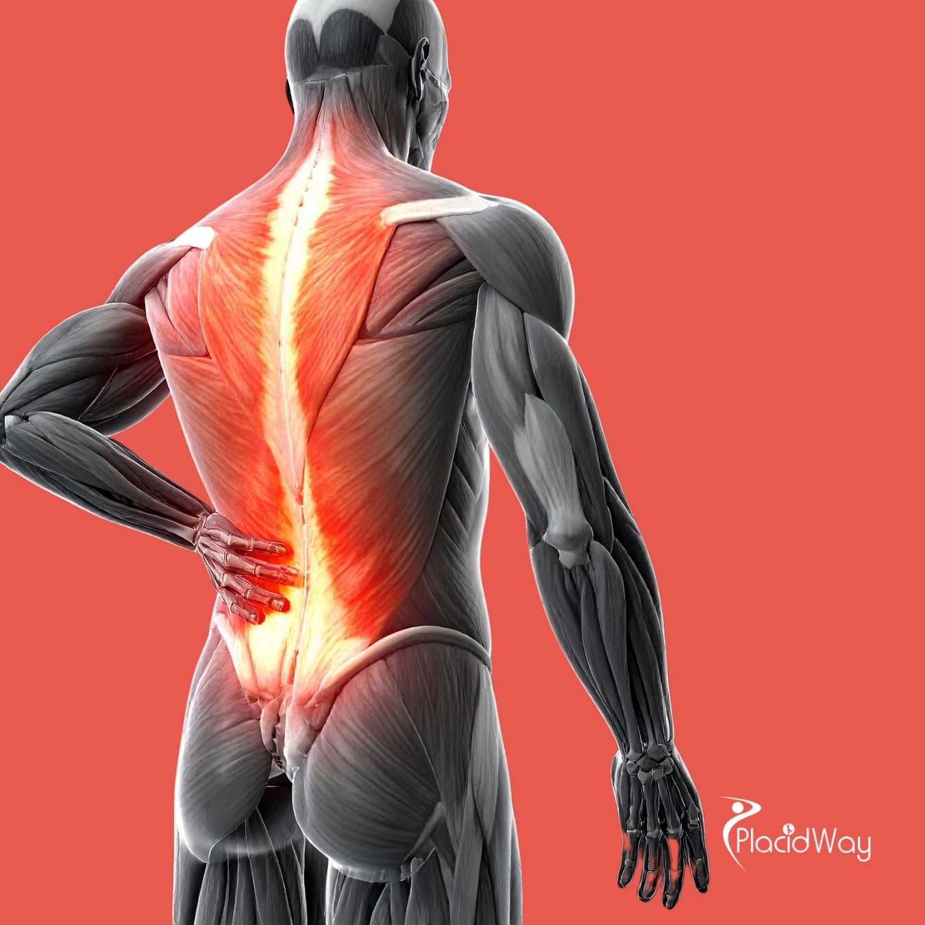 What Is the Cost of Stem Cell Therapy for Spine Arthritis in Mexico?
