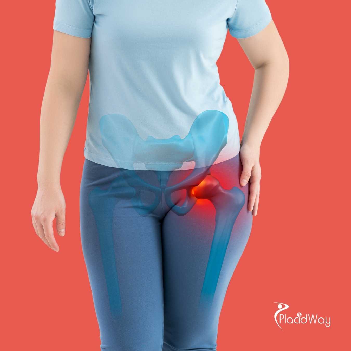 What Is the Success Rate for Hip Replacement Surgery in Mexico?