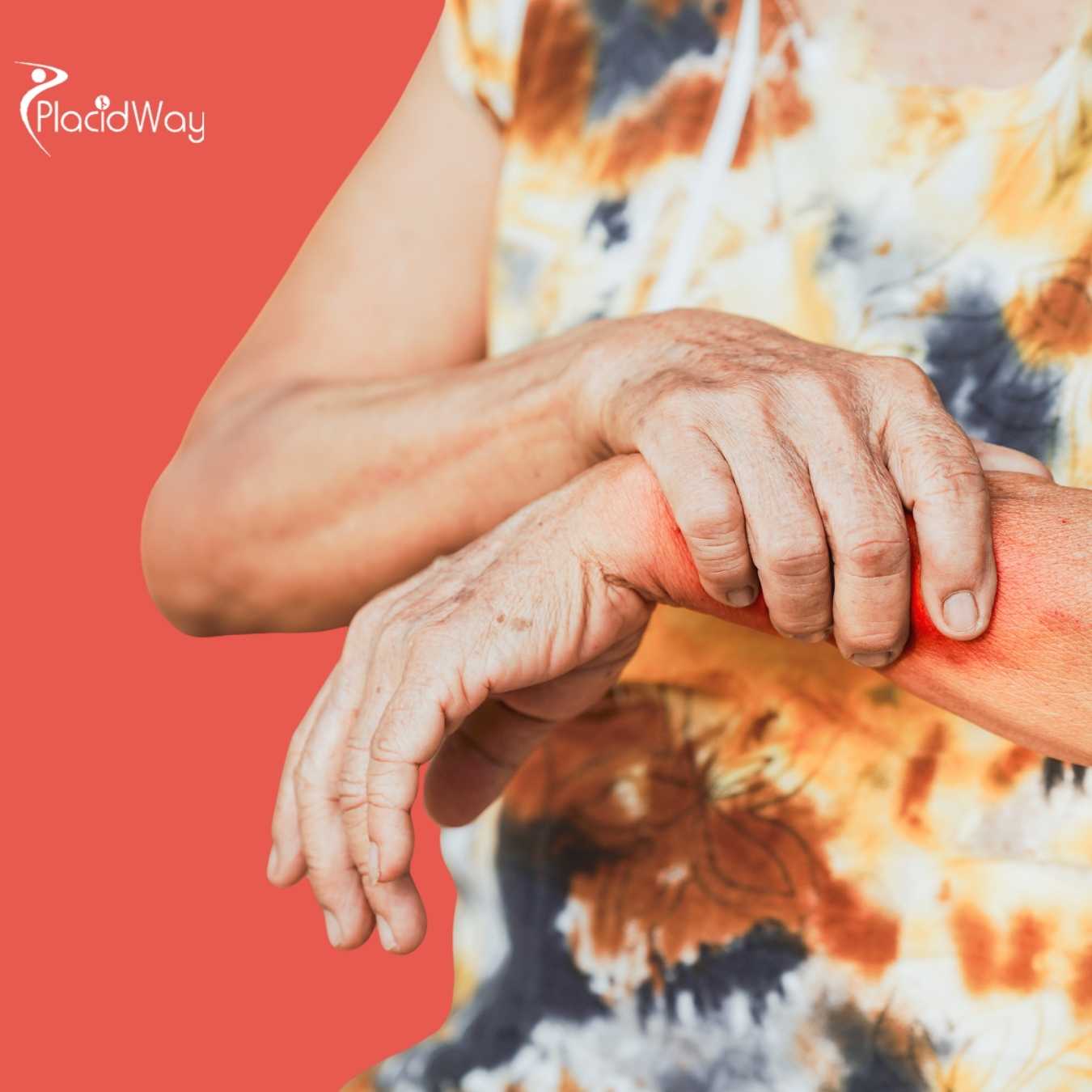 Is it safe for Lupus patients with kidney involvement to travel to Puerto Vallarta for treatment?