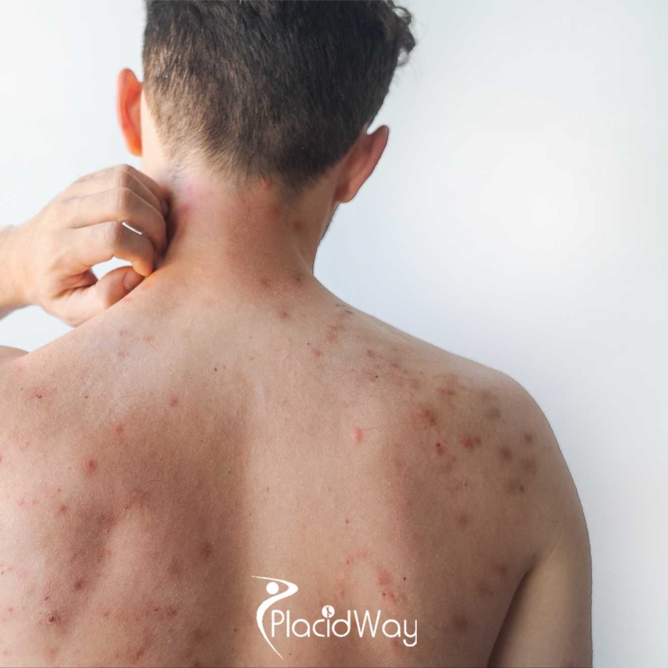 Guadalajara Stem Cells vs. Canadian Biologics: Which is Better for Psoriasis Relief?