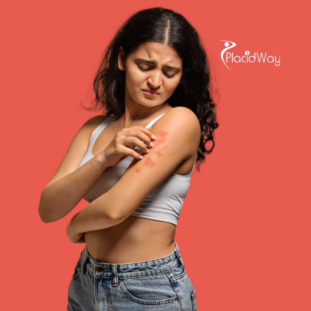 Can You Have Lyme Disease Without a Bull’s-Eye Rash? 