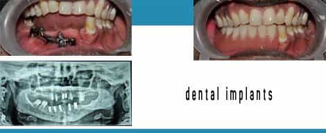 Dental Implant