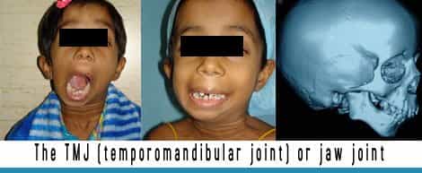 The Tmj Temporomandibular Joint Or Jaw Joint