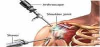 Arthroscopyi