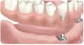 Dental Prostheses