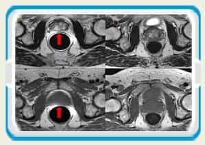 Prostate Cancer Therapy, Germany