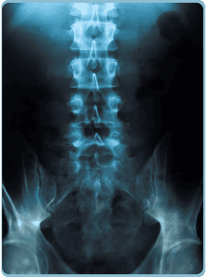 Total Hip Replacement Procedure in India