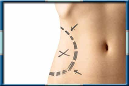 Tummy Tuck Procedure Wonjin Beauty Medical Group
