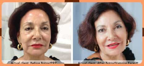 Anti Aging Treatment in Bali, Indonesia