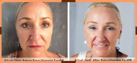 Anti Aging Treatment in Bali, Indonesia